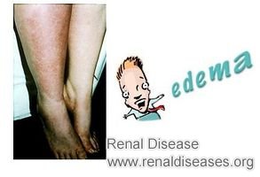 Good Medicines: Swelling on Legs for Mild Renal Failure Patients