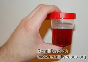 Polycystic Kidney Disease and Urinating Blood
