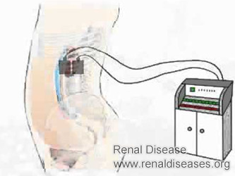 What Treatment Can Treat Kidney Failure Well