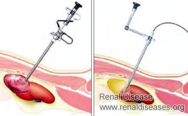 How Can I Treat Simple Cysts on Both Kidneys