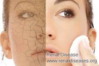 Dry Skin Around Mouth with IgA Nephroapthy