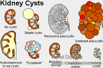 Hemorrhagic Renal Cyst Treatment