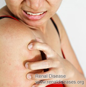 The Treatment for Body Itching Due to CKD