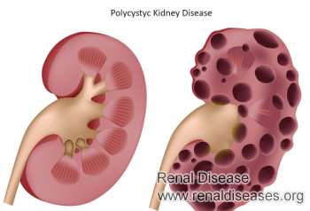 Polycystic Kidney Disease with Creatinine 5.5