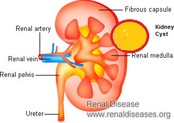 What Is the Best Treatment for One Cortical Renal Cyst 10cm