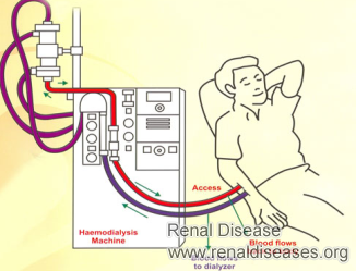Does 10% GFR Indicate for Patients Having Frequent Dialysis