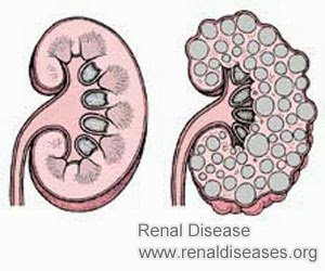 Can the Enlarged Kidney Come Back to Its Normal Size