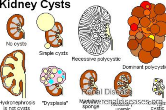 What Happens If One Has a Left Renal Simple Cortical Cyst