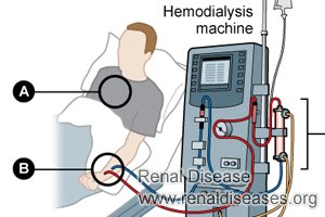 What Kidney Level Do Need to Start Dialysis
