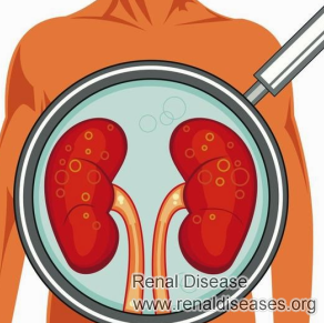 How Serious Is Renal Parenchymal Disease
