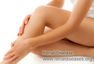 Do Swollen Legs Mean Kidney Failure