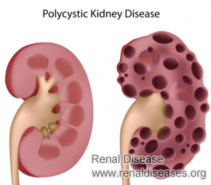 Is There Any Treatment for PKD and Polycystic Liver
