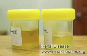 What Can I Do If I Have Foam in Urine with Diabetes