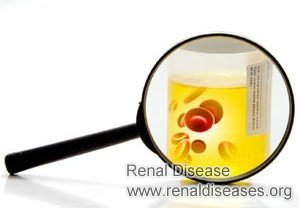 What Treatment Can You Take for Pain and Blood in Urine for PKD Patients