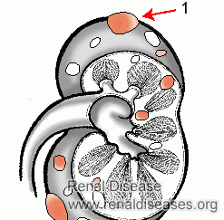 Is 1.2cm*1.0 cm Renal Cortical Cyst Dangerous