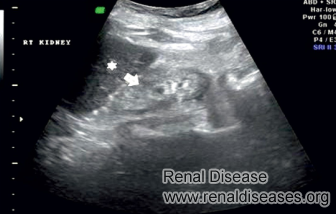 Some Facts about Increased Renal Parenchymal Echogenicity
