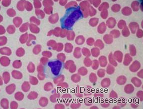 How Can Mononucleosis Affect Stage 4 Renal Failure