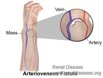 Is It Needed to Have a Artrtiovenous Fistula for Creatinine 3.7