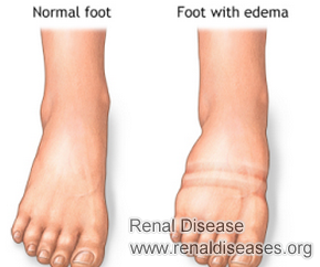 Leg and Foot Swelling in Stage 4 CKD: Causes and Treatment