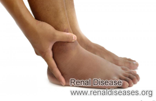 Swelling in Kidney Failure: Causes and Treatments