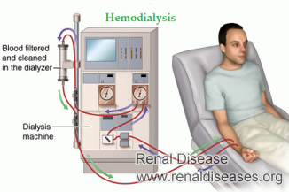 What Is CKD Stage 5 Patients with MHD Means 