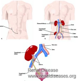 Is There Any Problems Having Second Kidney Transplant