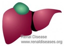 How Can I Shrink A 5 cm Cyst on My Liver with Kidney Cyst