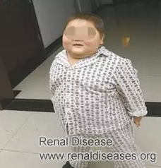 Hormones Do Harm to Kidney Disease Patients
