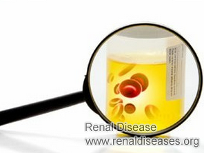 Polycystic Kidney Disease and Peeing Blood