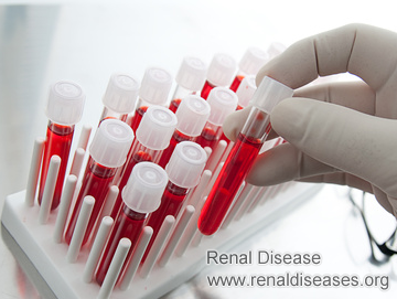 How Serious Is Creatinine Level 2.9 for Diabetic Nephropathy