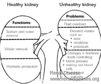 How Bad Is Stage 3 Chronic Kidney Disease