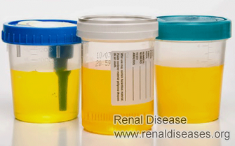 How Bad Can Be Foaming Urine in A Diabetes Patient