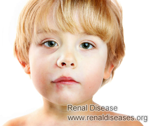 How Can I Reduce Swelling in My Face from Nephrotic Syndrome