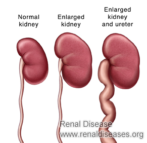 Kidney Enlargement Initial Stage: Is That A Major Problem