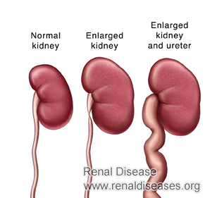 Natural Treatments for Both Swollen Kidneys