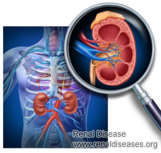 How Does IgA Nephropathy Affect Kidneys