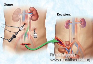Does Stage 3 CKD Patient Need Kidney Transplantation