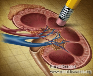 What Could Be Done If You Have 20% Function of Your Kidney