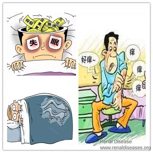 Treatment for Skin Itching Leg Restless And Sleep Problem in ESRD (Uremia)