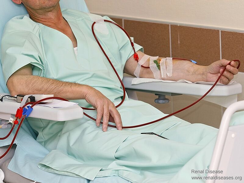 Treatment to Avoid Dialysis for High Creatinine Patients With Kidney Failure