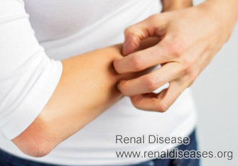 Stage 4 Kidney Failure And Itchy Skin
