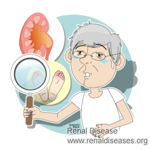 How to Prevent Diabetic Kidney Disease for Diabetes Patients