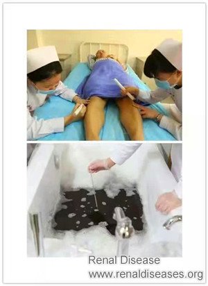 How to Treat Kidney Failure Without Dialysis