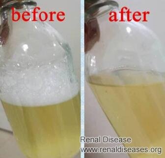 Can We Reverse Kidney Damage due to Proteinuria