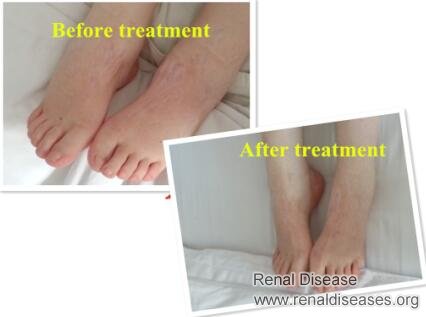 Lupus Nephritis: Say Good Bye to Severe Swelling