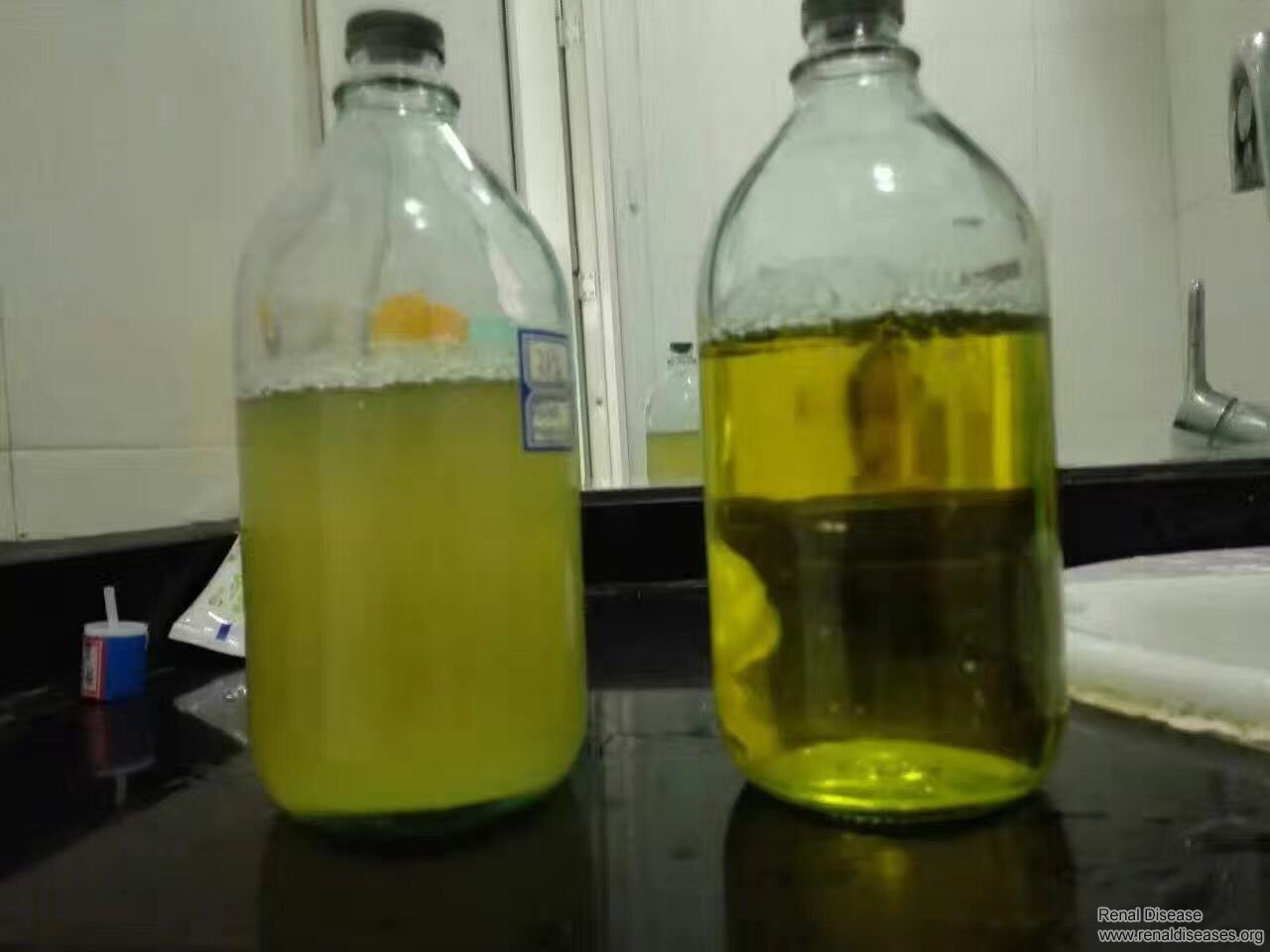 How Much Protein Should You Reduce in Urine to Avoid Uremia