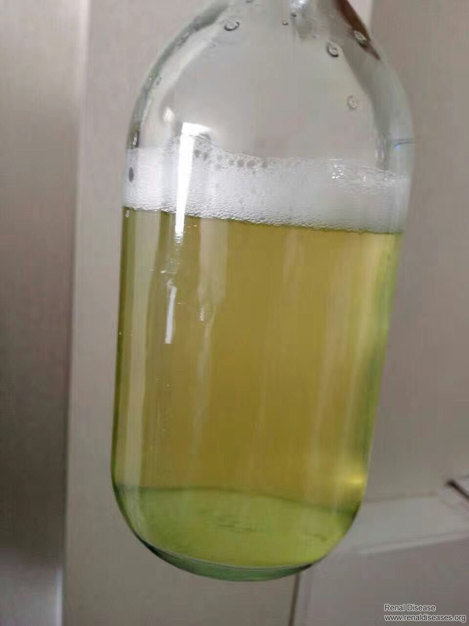 Albumin in Urine ++: How to Reduce It for PKD Patients
