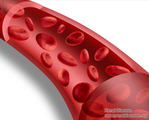 How to Improve Blood Flow to the Kidneys for Kidney Failure Patients