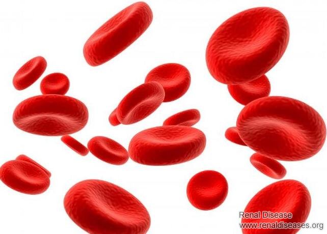Causes of Anemia in Hemodialysis Patients