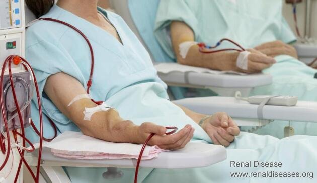 Can A Person Do Dialysis Only Twice A Week